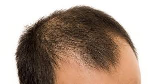 Baldness